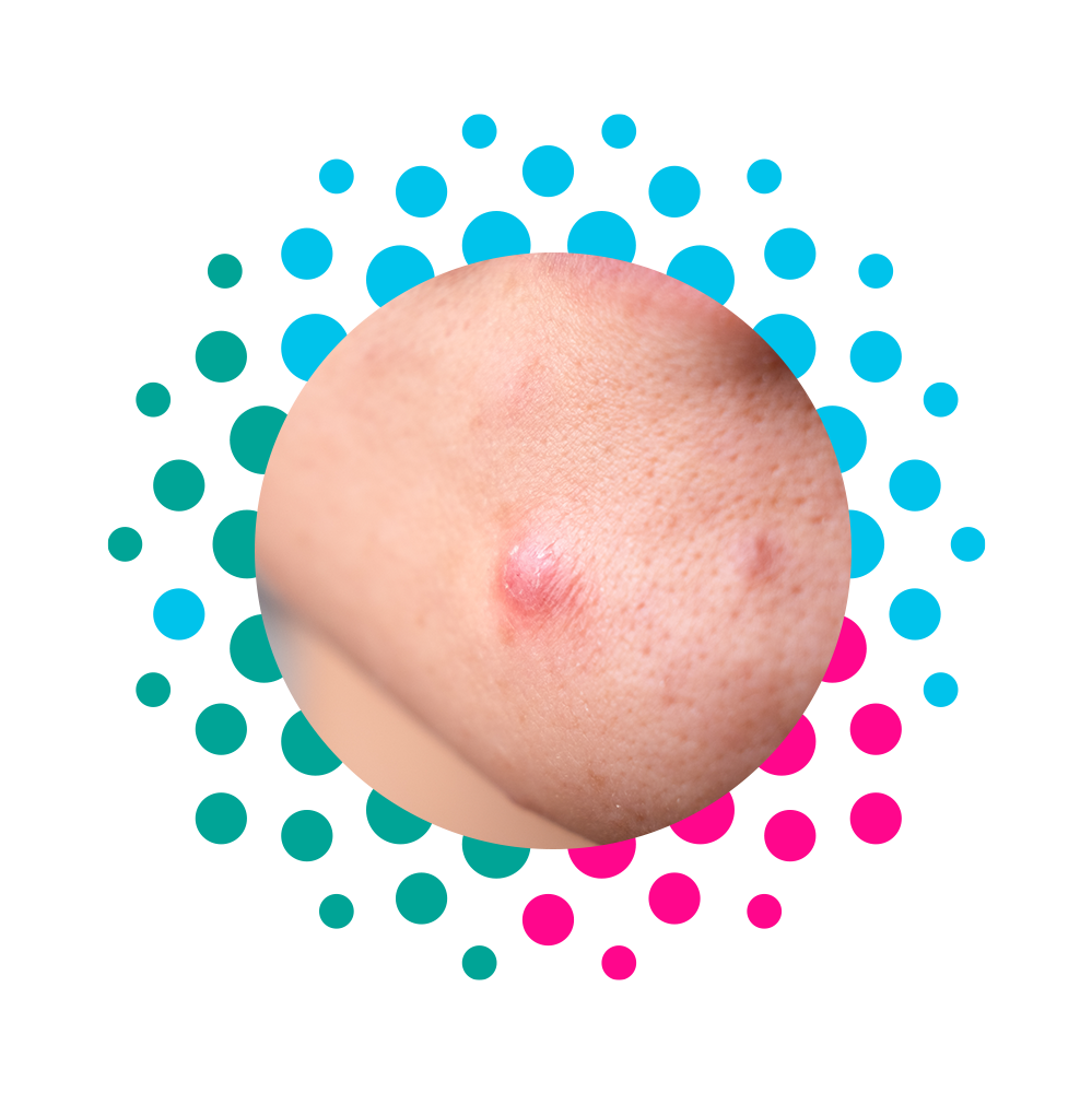 montana_pharma-acne